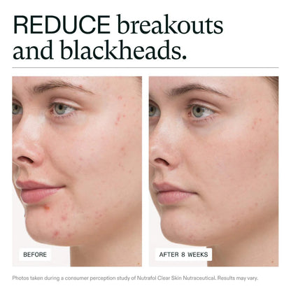Before and after comparison of a person's face with text indicating reduction of breakouts and blackheads.